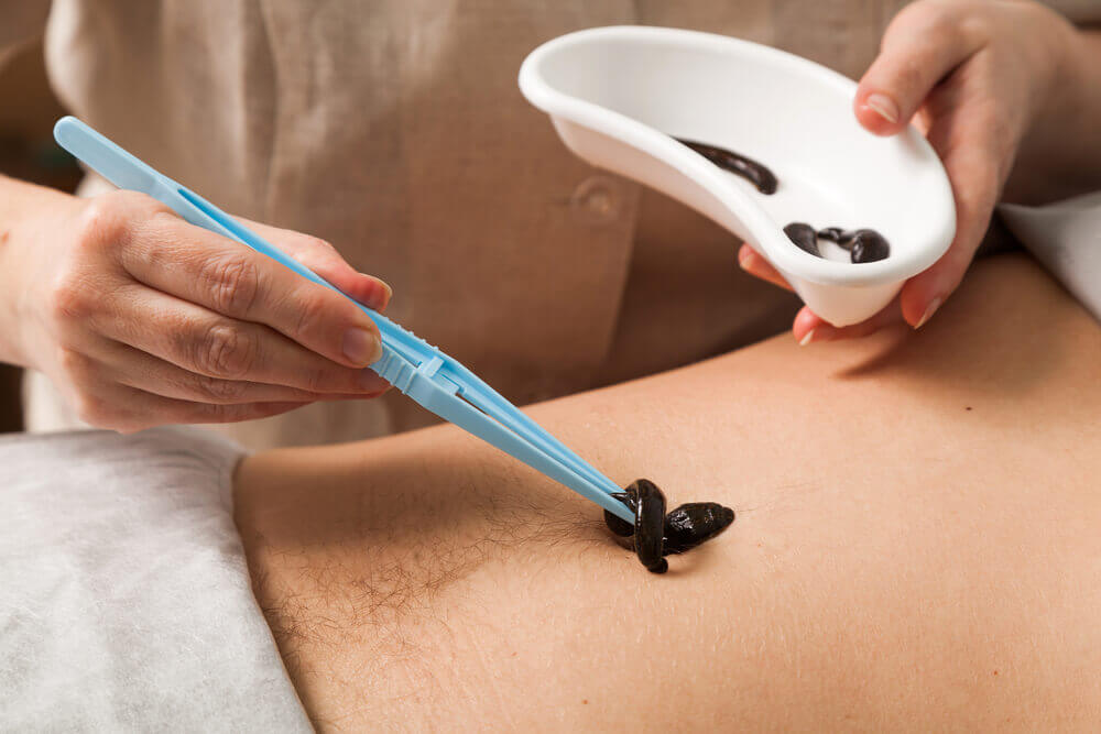 sanguisughe applicate sulla schiena di un paziente per rappresentare master in hirudoterapia
